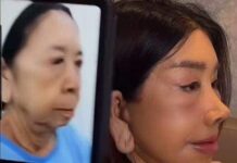 En China, le quitan 30 años de edad a una mujer de 70 años con una cirugía, el resultado es realmente impresionante.