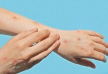 Sonora permanece con 2 casos importados de Mpox; sin casos autóctonos