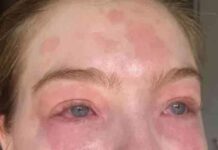 Joven es alérgica a su novio, sufre erupciones en la piel y lagrimeo de ojos cada vez que está con él.